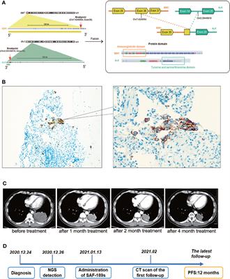 Frontiers SDK1 ALK Fusion In A Lung Adenocarcinoma Patient With